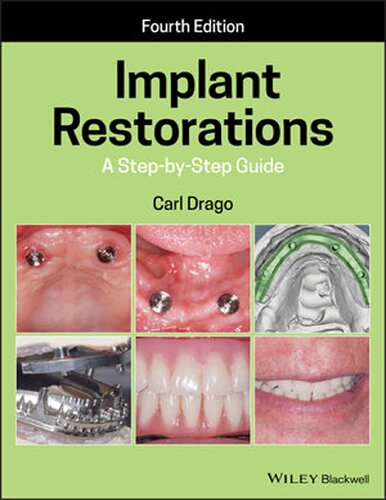 Implant Restorations: A Step-by-Step Guide (PDF Instant Download)