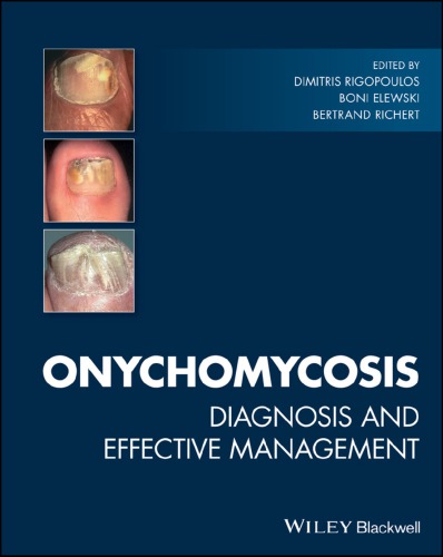 Onychomycosis : diagnosis and effective management (PDF Instant Download)