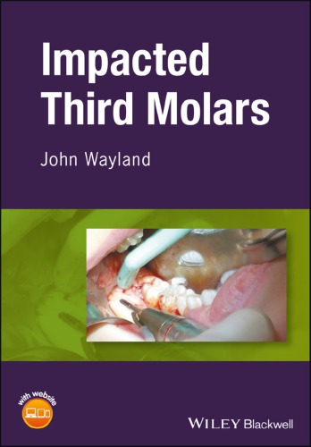 Impacted third molars (PDF Instant Download)