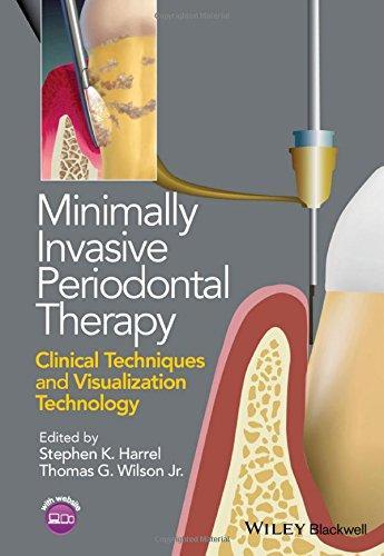 Minimally Invasive Periodontal Therapy Clinical Techniques And Visualization Technology (PDF Instant Download)