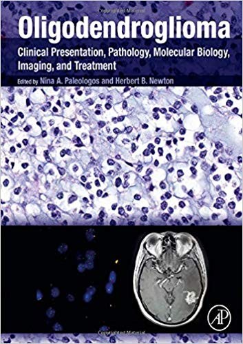 Oligodendroglioma: Clinical Presentation, Pathology, Molecular Biology, Imaging, and Treatment (PDF Instant Download)