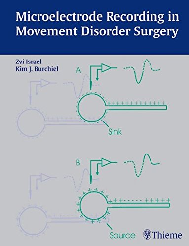 Microelectrode recording in movement disorder surgery  Edition (PDF Instant Download)