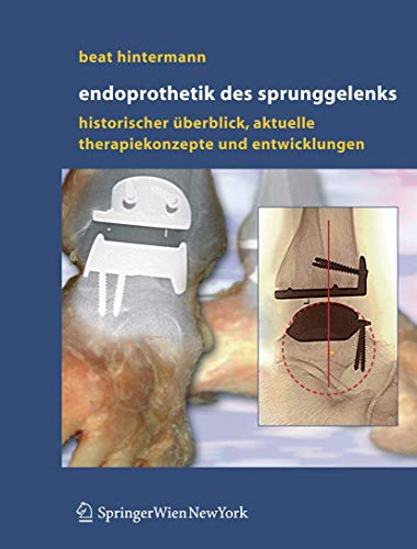 Endoprothetik des Sprunggelenks: Historischer Überblick, aktuelle Therapiekonzepte und Entwicklungen 1. A. Edition (PDF Instant Download)