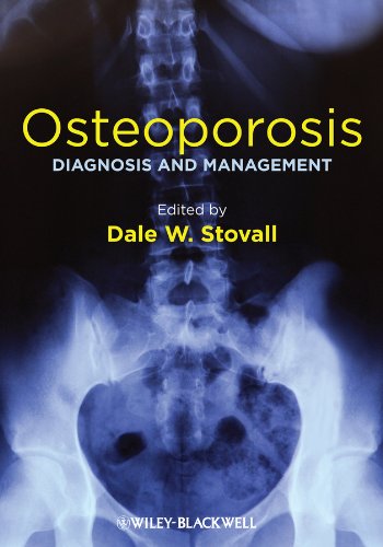 Osteoporosis: Diagnosis and Management 1 Edition (PDF Instant Download)